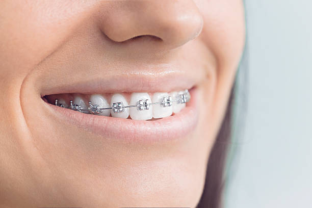 Dental Bonding in Maysville, MO